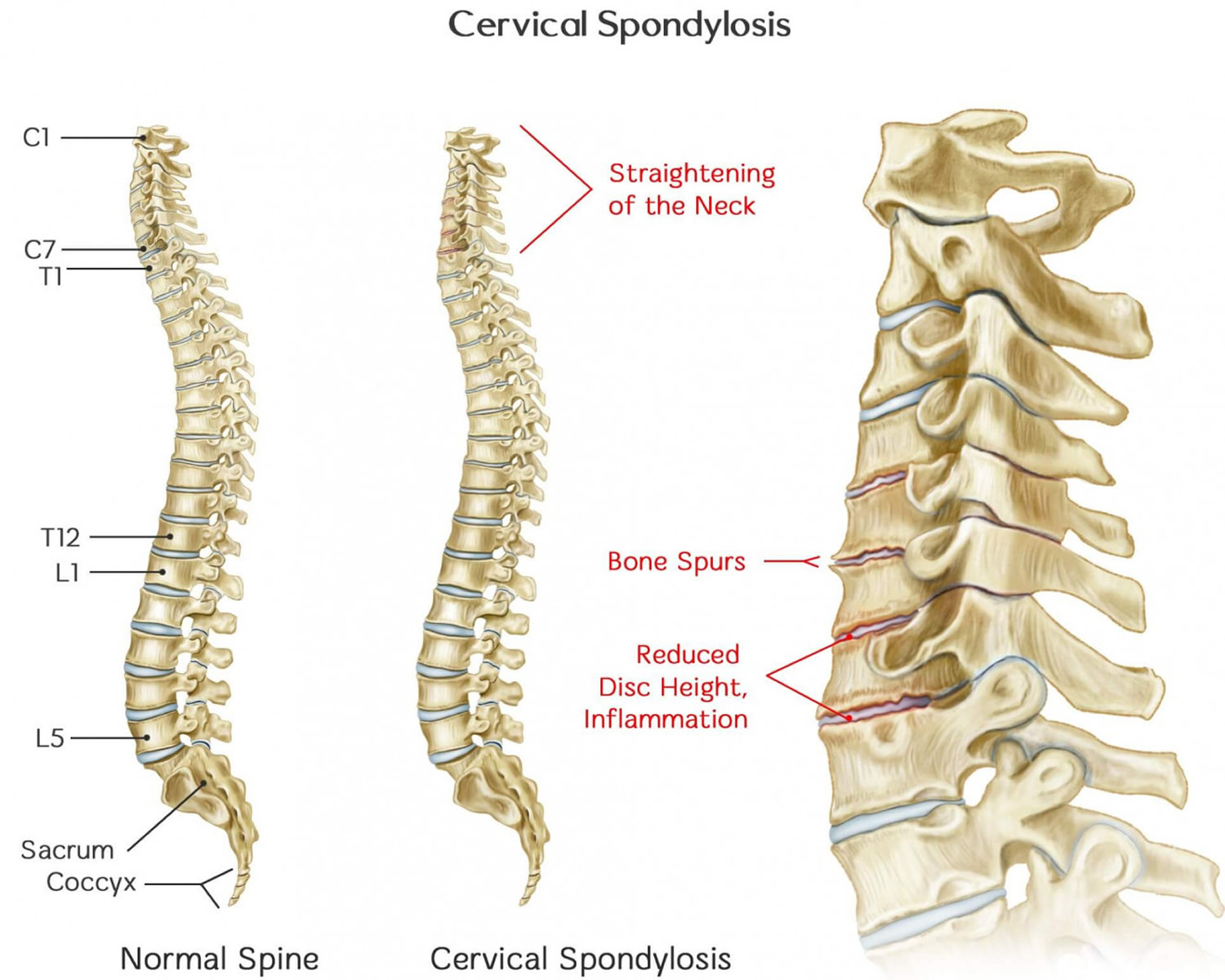 Cervical Spondylosis - Causes, Symptoms, Exercises, Treatment