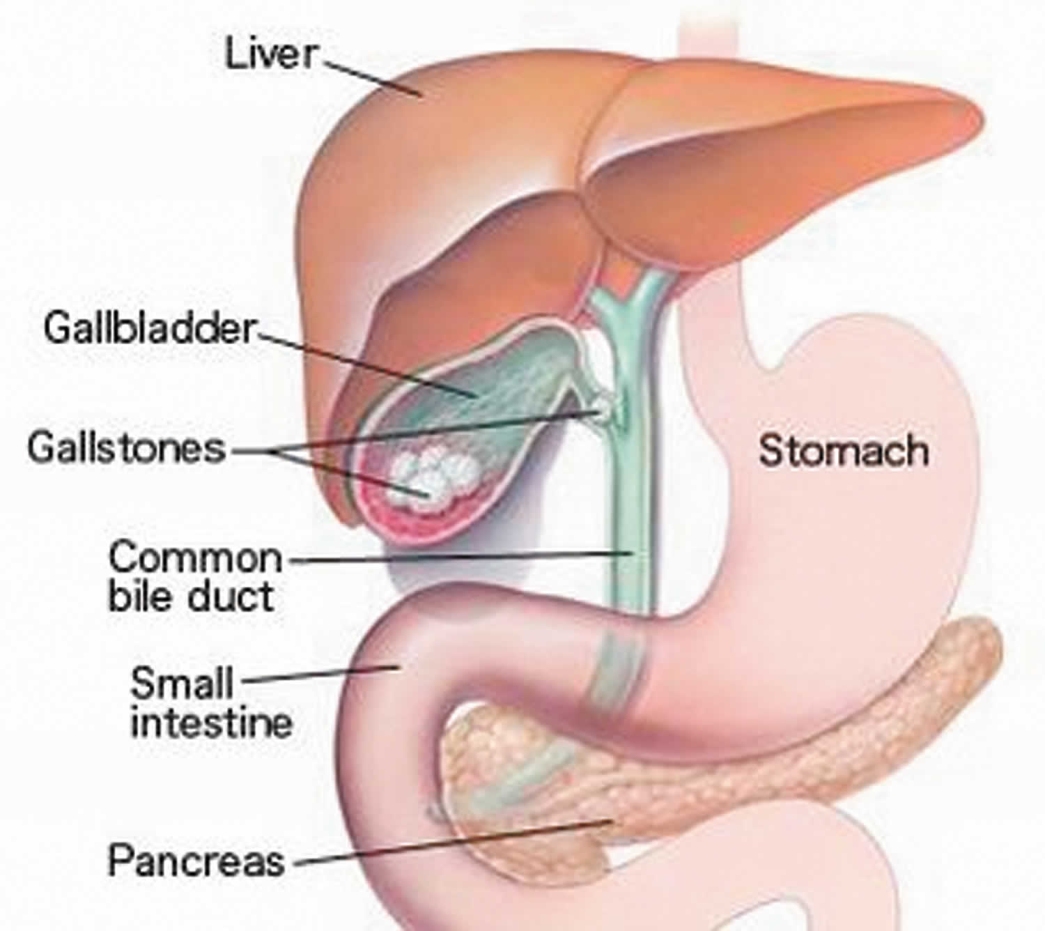 Cholecystitis Acute Chronic Causes Symptoms Treatment