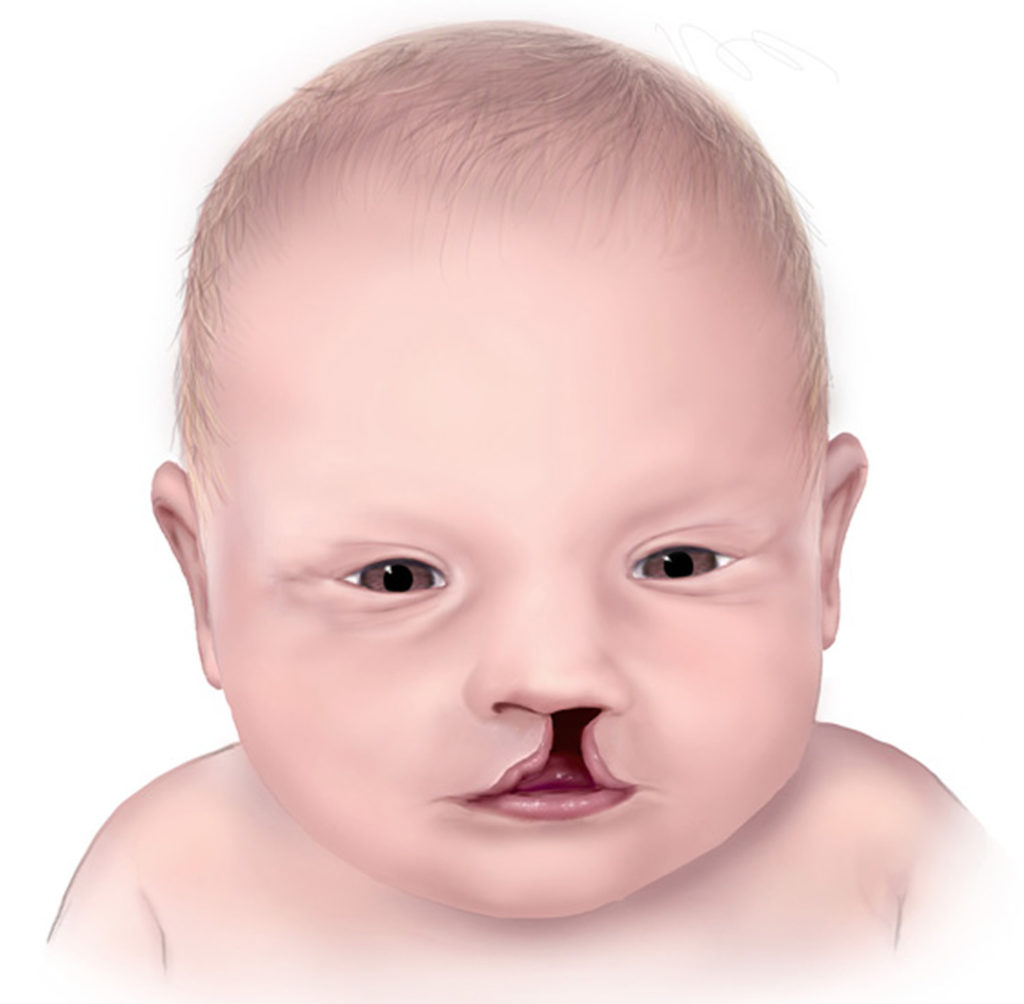 新生儿上唇有裂缝图片,初生婴儿隐形唇裂图片 - 伤感说说吧