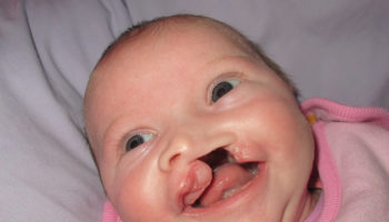 cleft-lip-and-cleft-palate