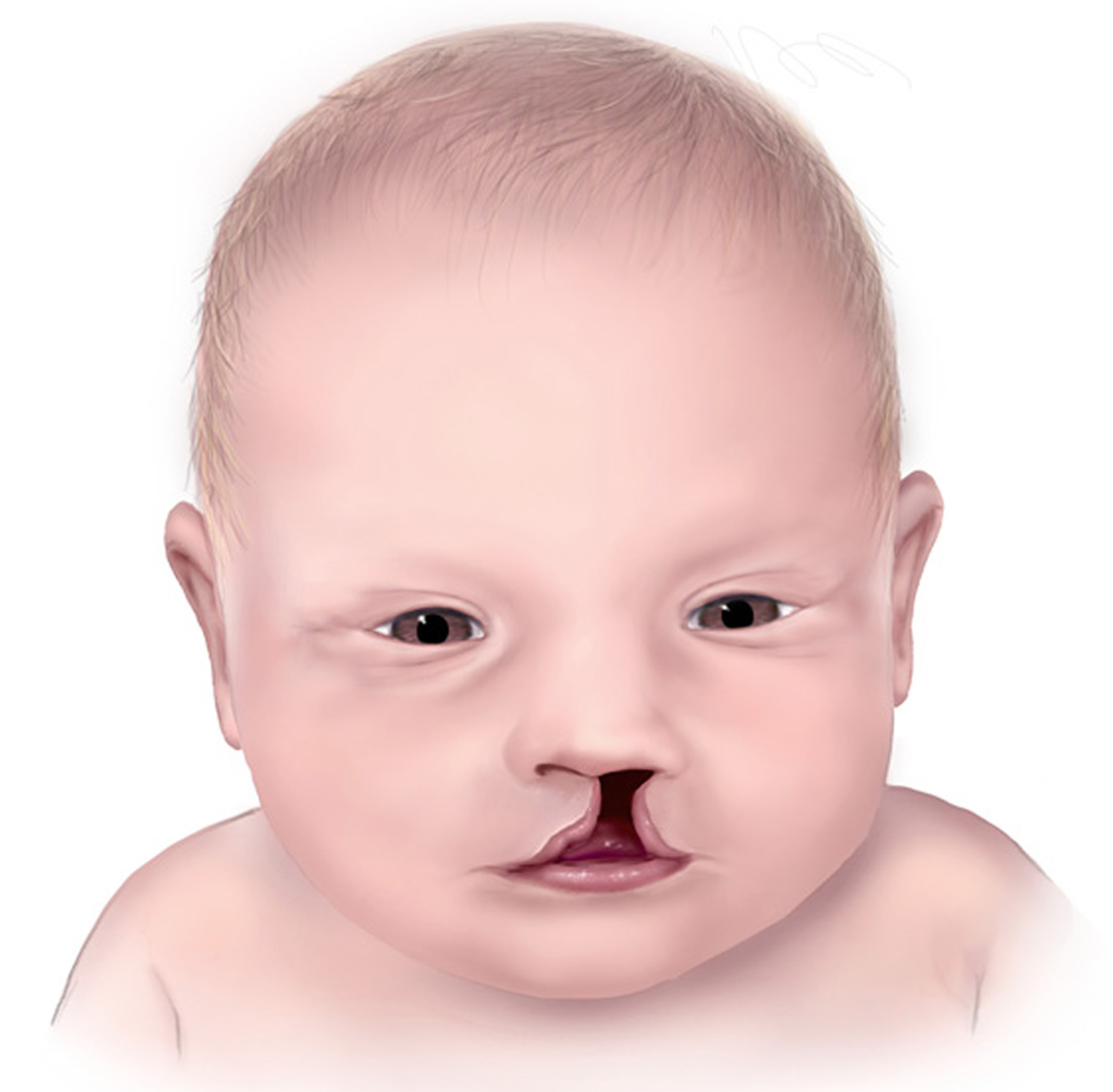 What Does Research Cleft Palate Mean