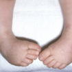 club foot