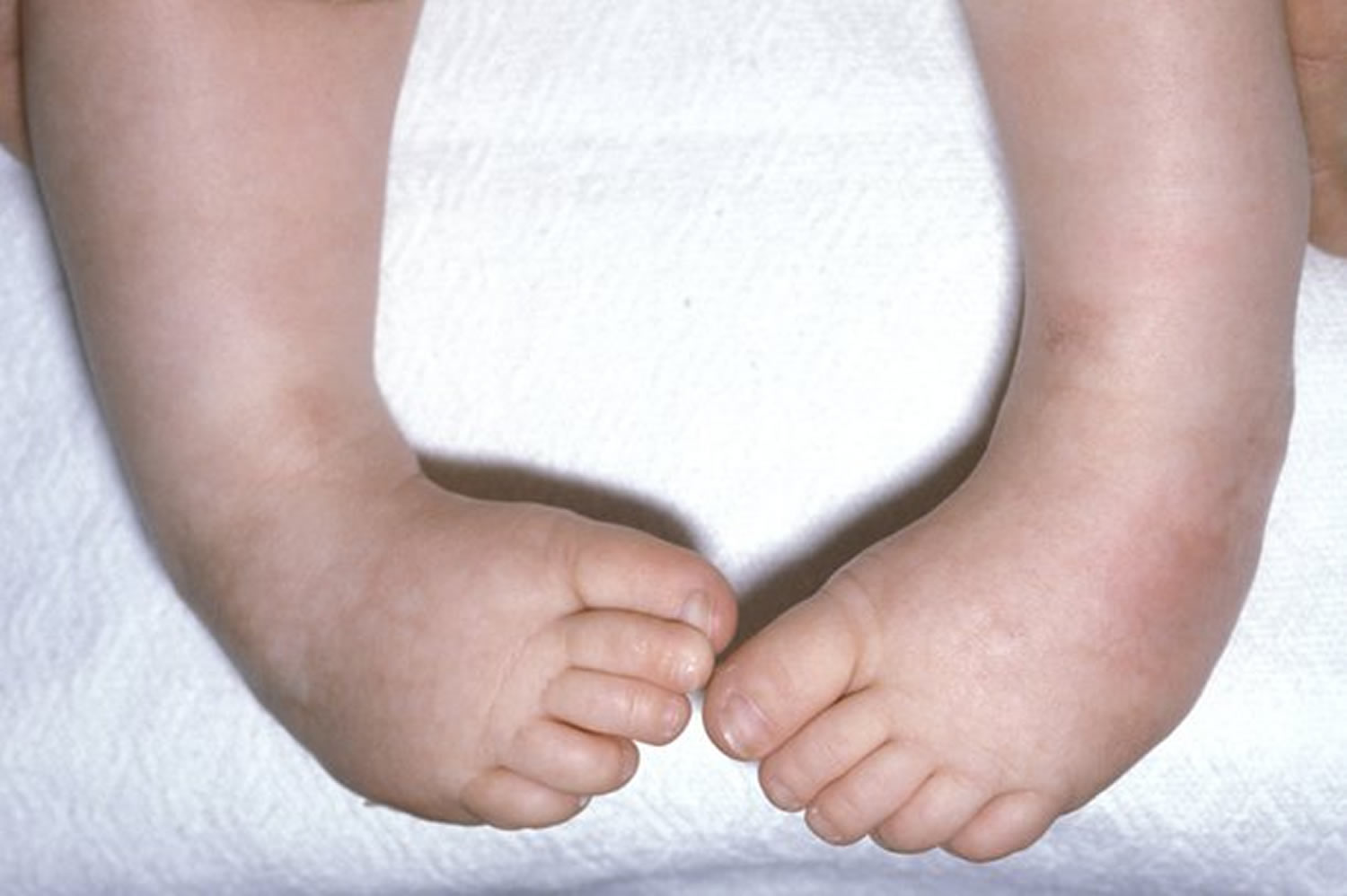 Club Foot Congenital Clubfoot Causes Types Symptoms Treatment