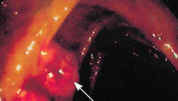 colon polyps