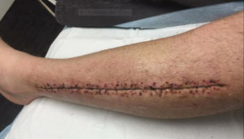 compartment syndrome