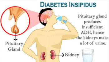 diabetes insipidus