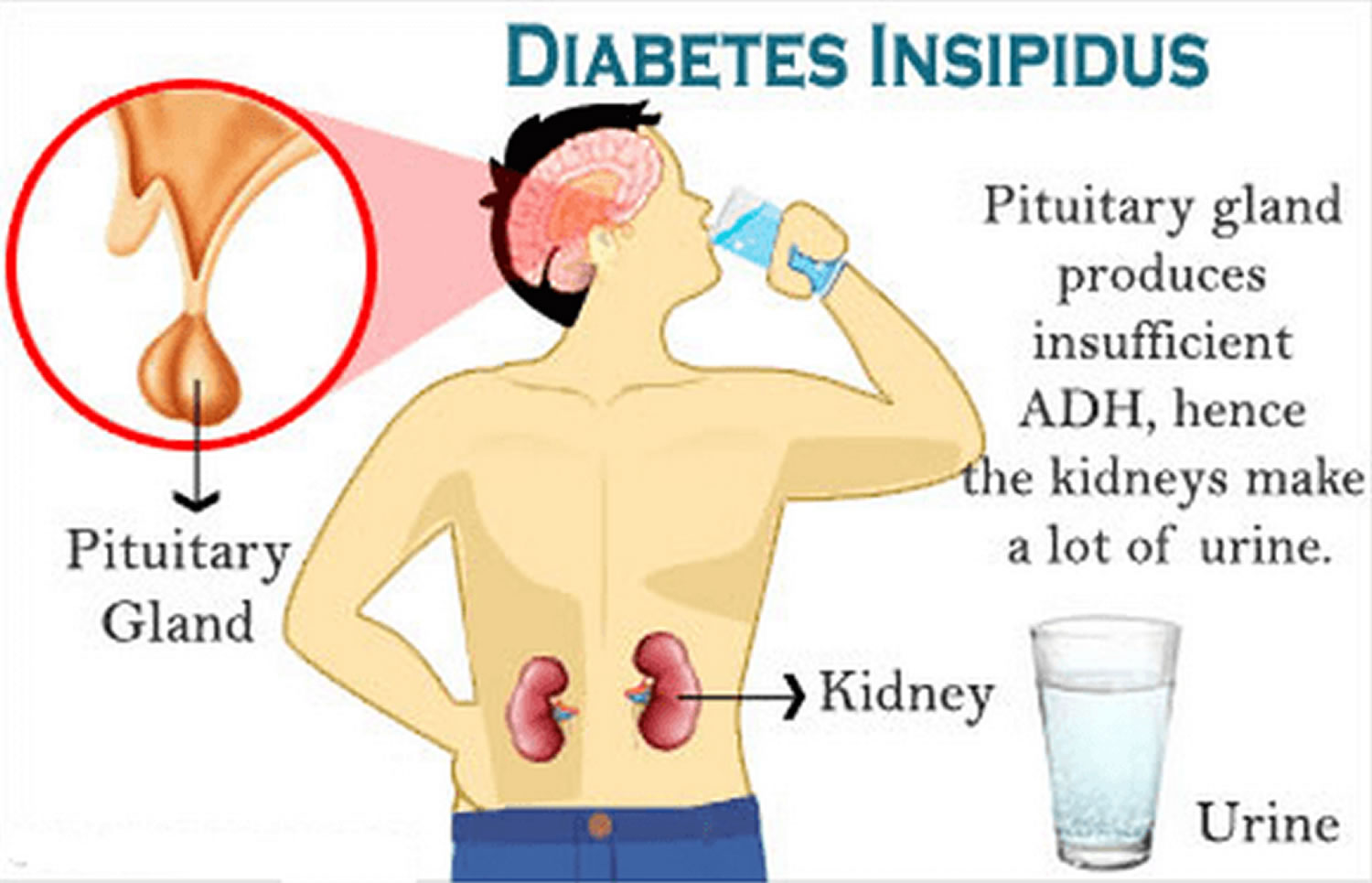  Diabetes  Insipidus  Causes Symptoms Diagnosis Treatment