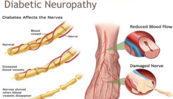 diabetic neuropathy