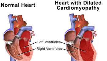 dilated cardiomyopathy
