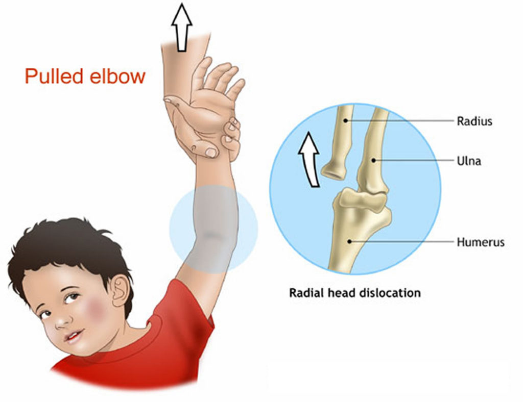 Dislocated Elbow Causes, Signs, Symptoms, Recovery & Treatment
