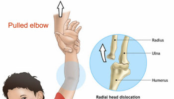 dislocated elbow toddler