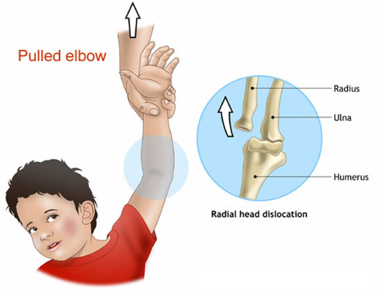 Dislocated Elbow Causes, Signs, Symptoms, Recovery & Treatment