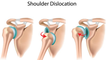 dislocated shoulder
