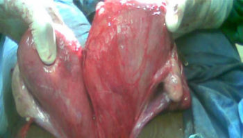 double uterus