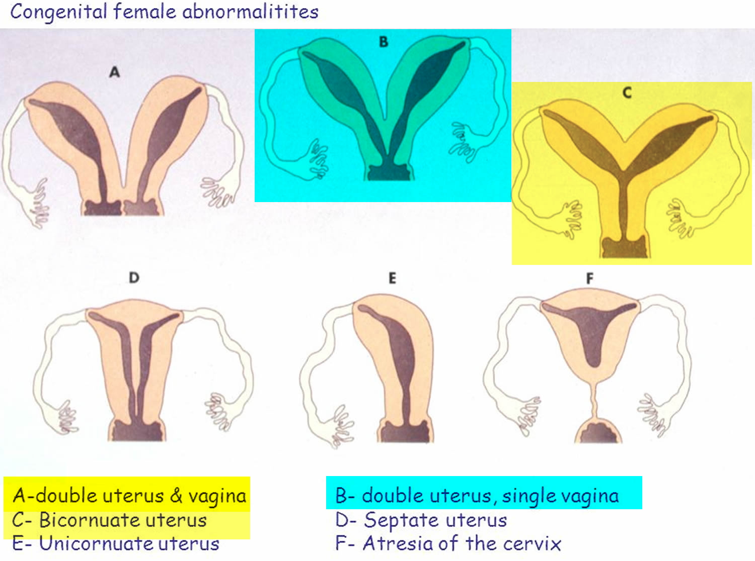 Single horn uterus