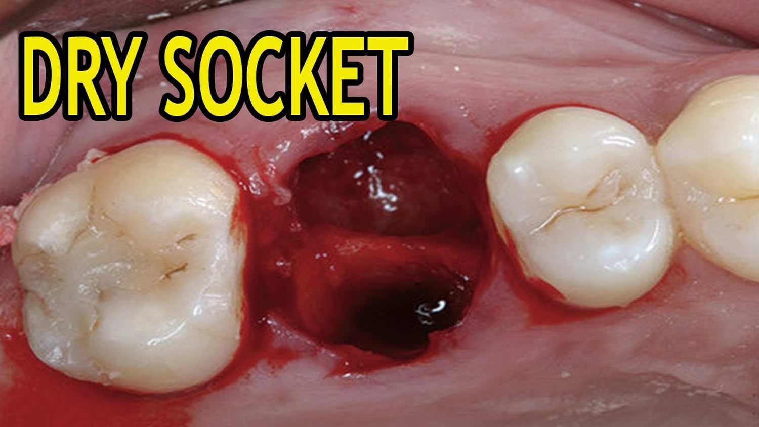 Dry Socket - Causes, Signs, Symptoms, Prevention & Treatment