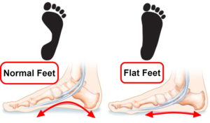 do i have flat feet