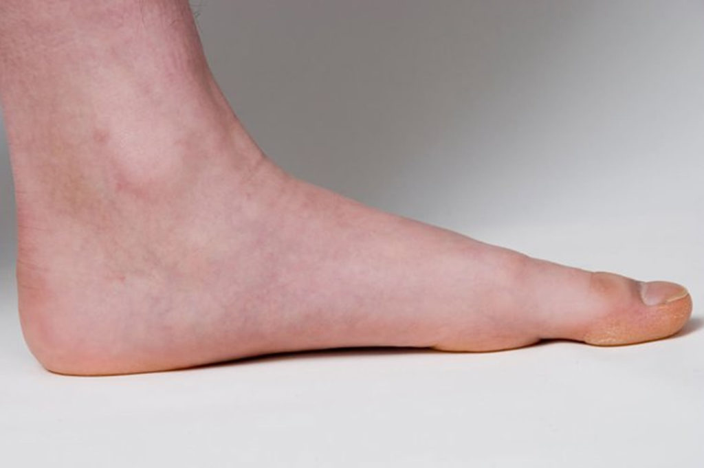 Flat Feet Causes In Adults & Children, Symptoms, Exercises & Treatment