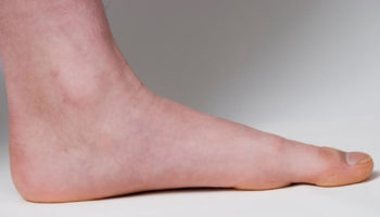 flat feet