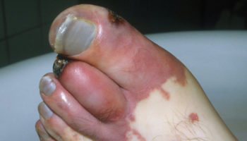 gangrene foot