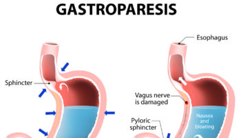gastroparesis