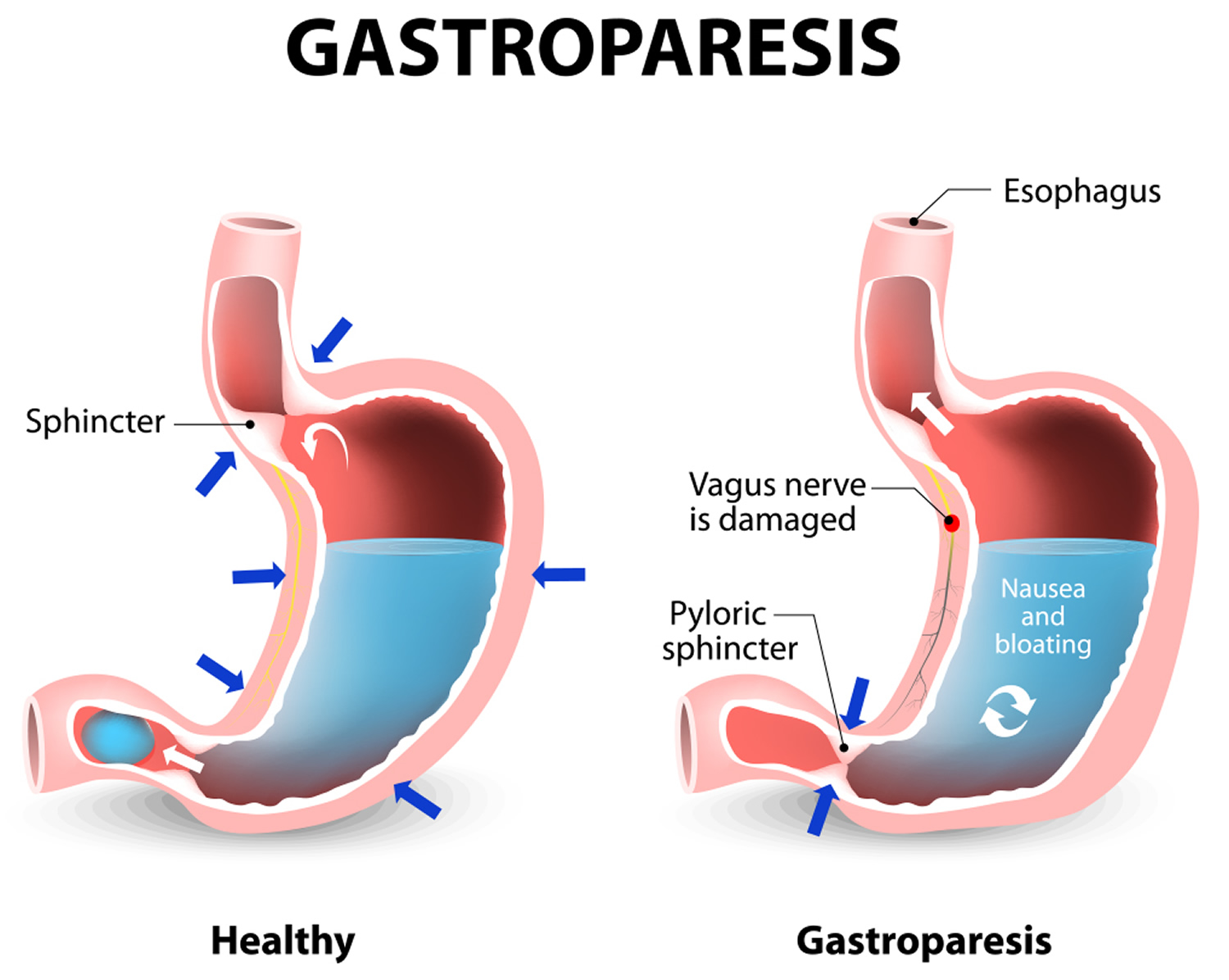 Gastroparesis Causes, Symptoms, Diet, Medications & Treatment