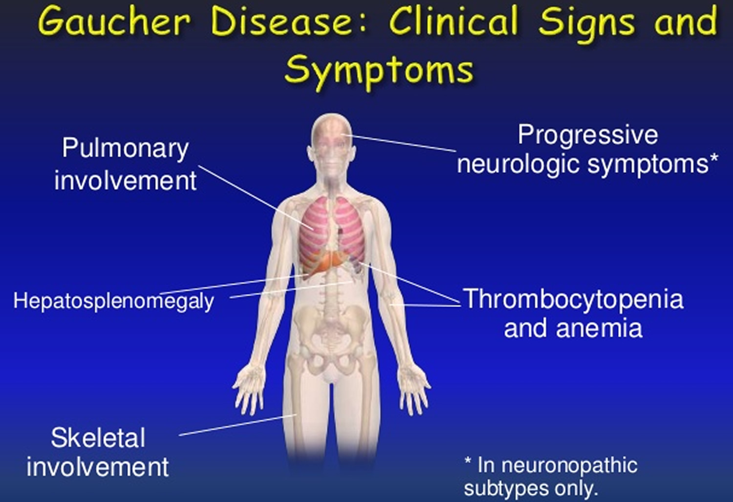 gaucher disease