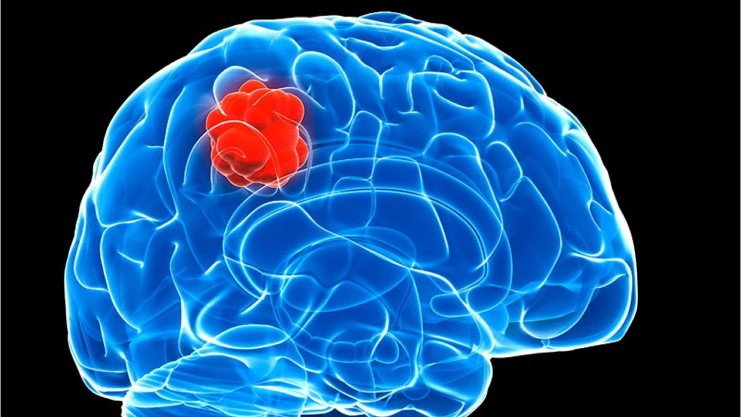 Glioma Causes Signs Symptoms Type Diagnosis Treatment