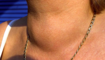 goiter
