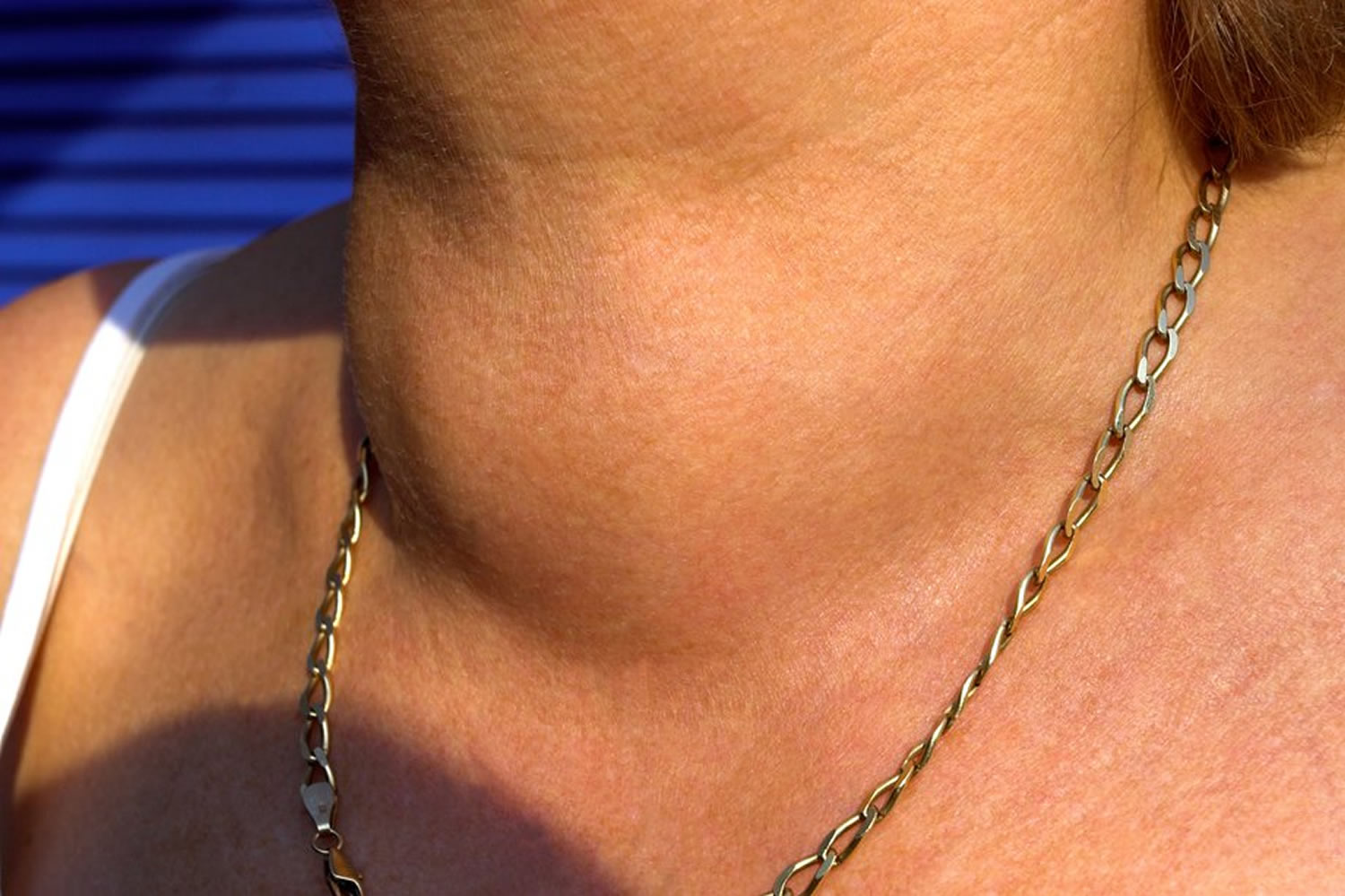 What Do Swollen Thyroid Glands Look Like