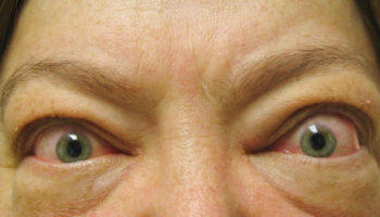 graves disease