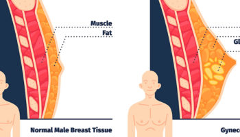 gynecomastia 1