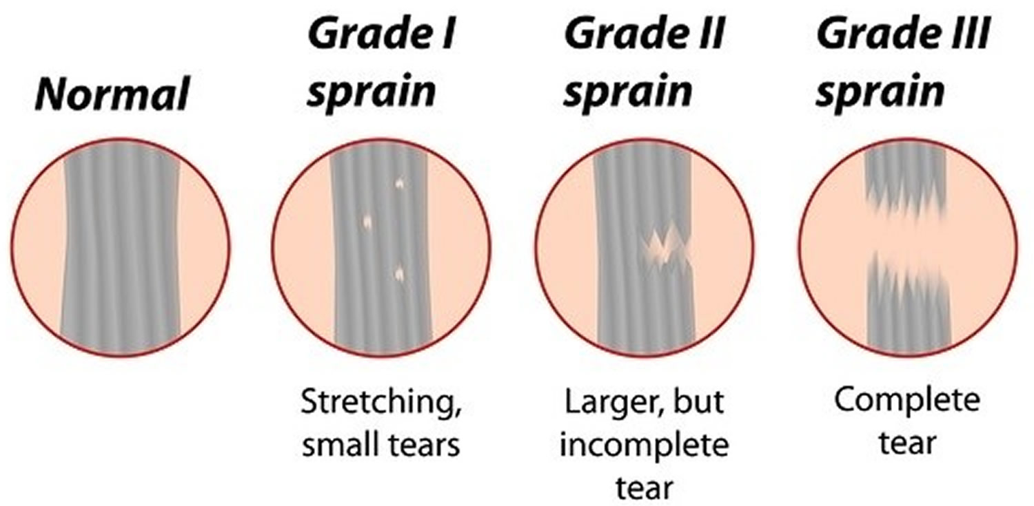 1 for grade strain exercises hamstring Injury & Causes, Treatment Hamstring   Symptoms, Recovery Time