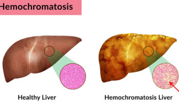 hemochromatosis