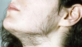 hirsutism