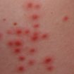 hot tub folliculitis 2