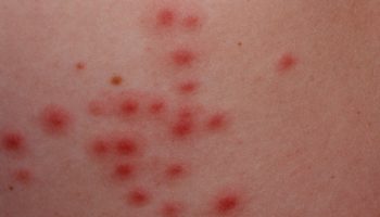 hot tub folliculitis 2
