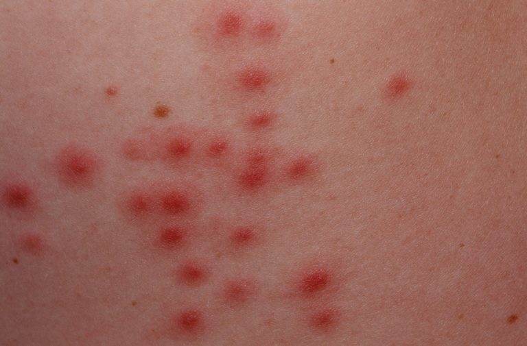 Folliculitis Causes Signs Symptoms How To Get Rid Of Folliculitis