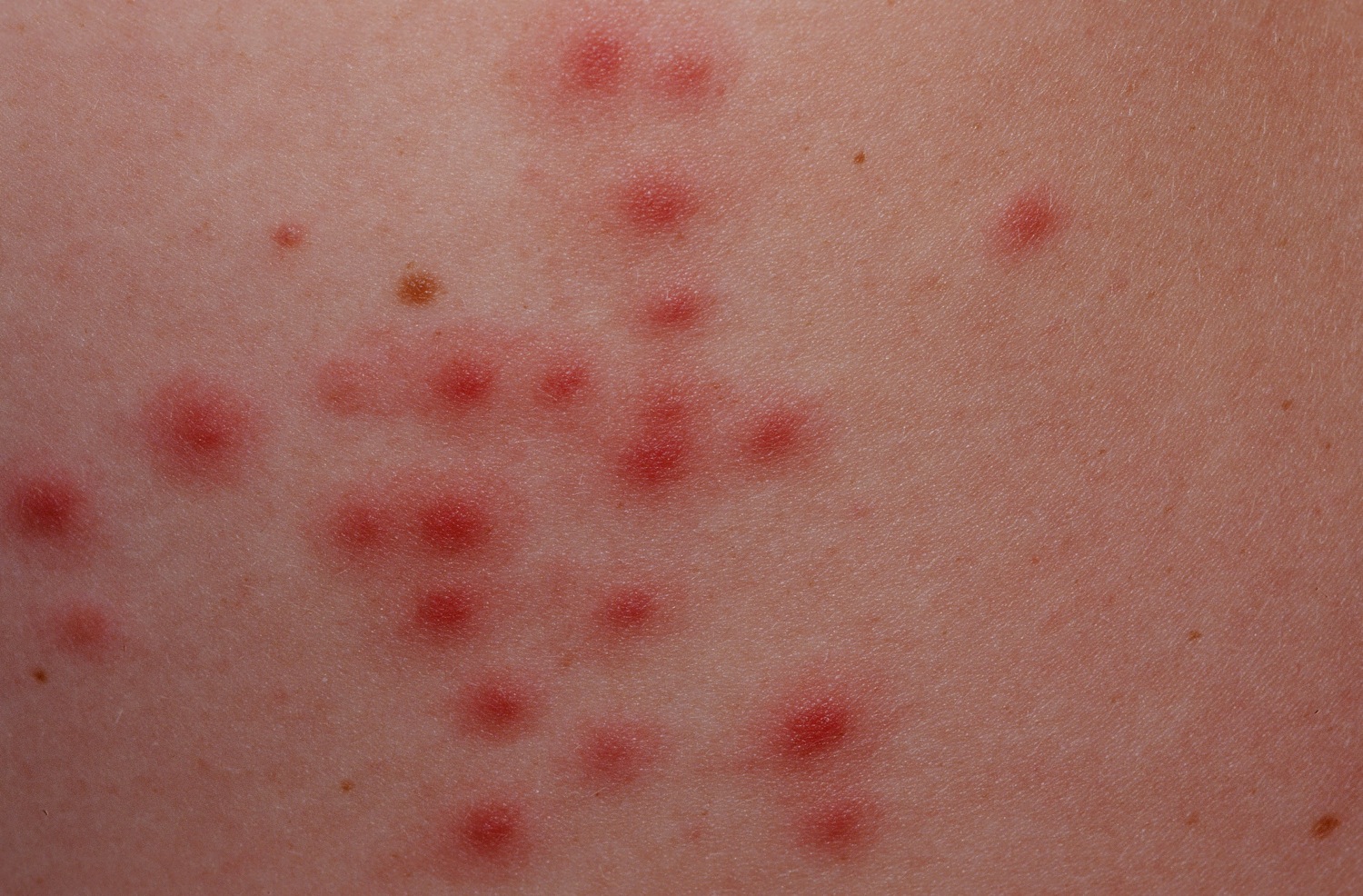 Folliculitis Causes Signs Symptoms How To Get Rid Of Folliculitis 