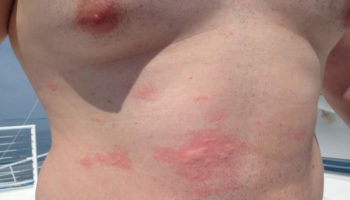 jellyfish sting