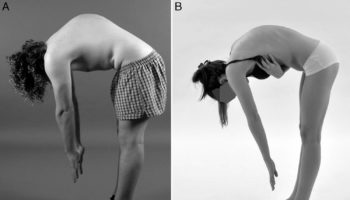 kyphosis 1