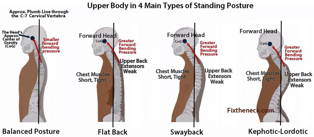 Kyphosis Causes Symptoms Exercises Surgery Treatment