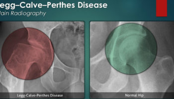 legg calve perthes disease