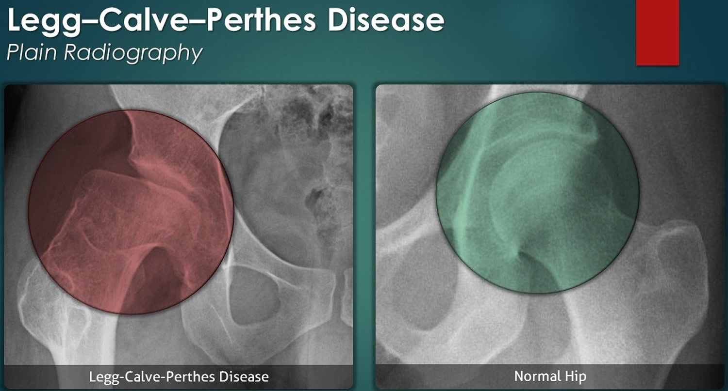Legg-Calve-Perthes Disease - Causes, Symptoms, Treatment