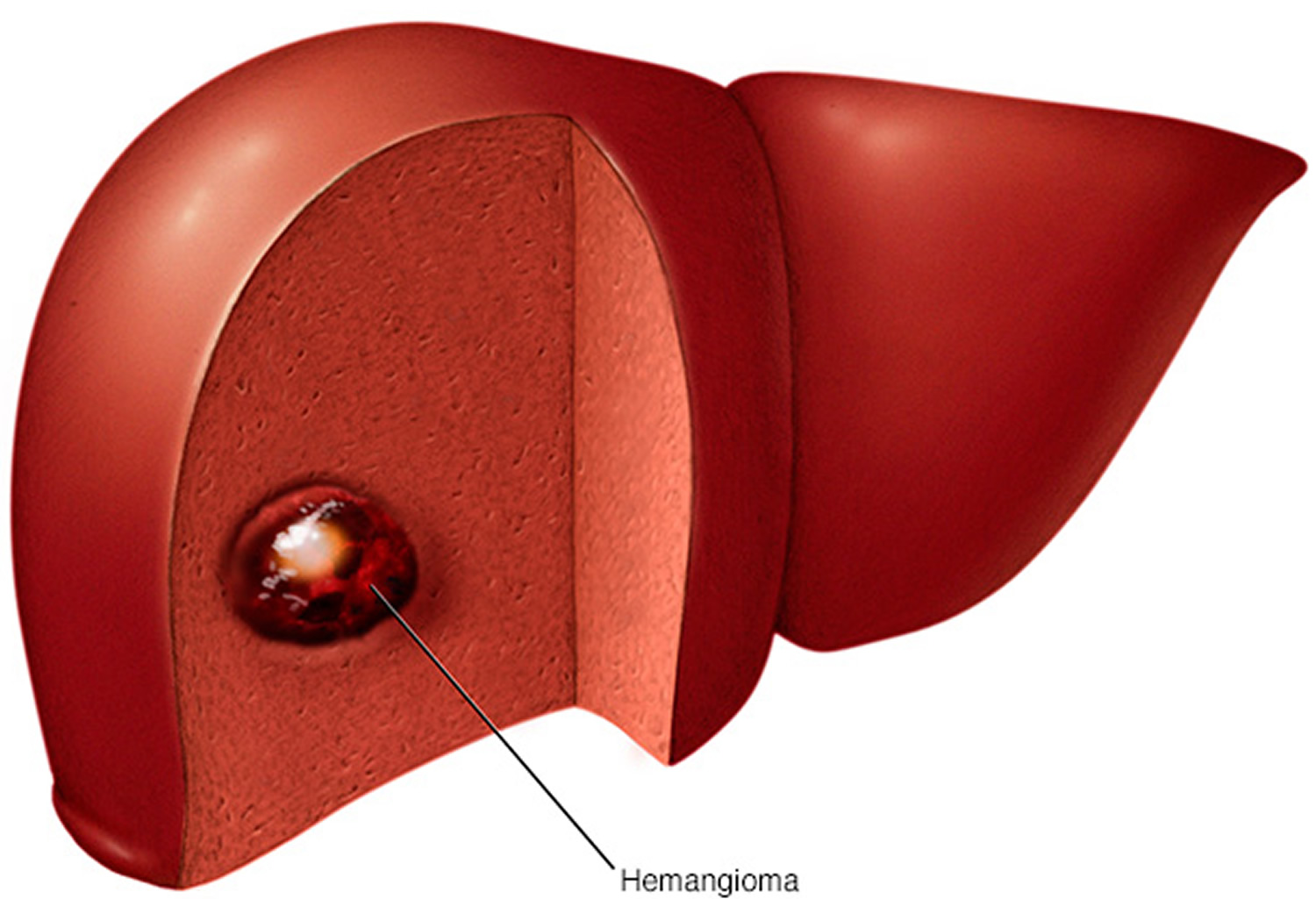 Hemangioma Hemangioma Of Skin Spine Liver Causes Treatment   Liver Hemangioma 