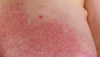 mastitis