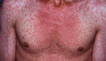 measles
