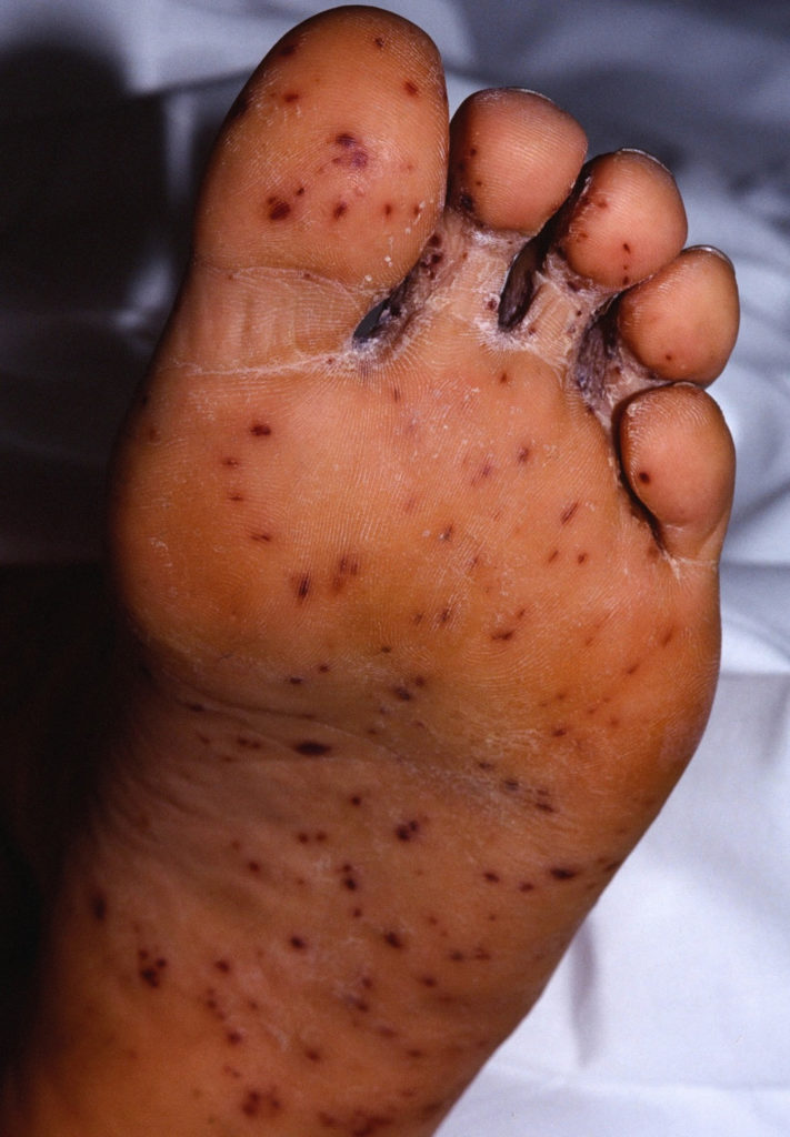 Measles - Causes, Rash, Symptoms, Signs, Measles Treatment