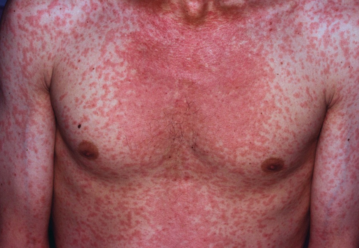 Do You Get A Rash With Measles