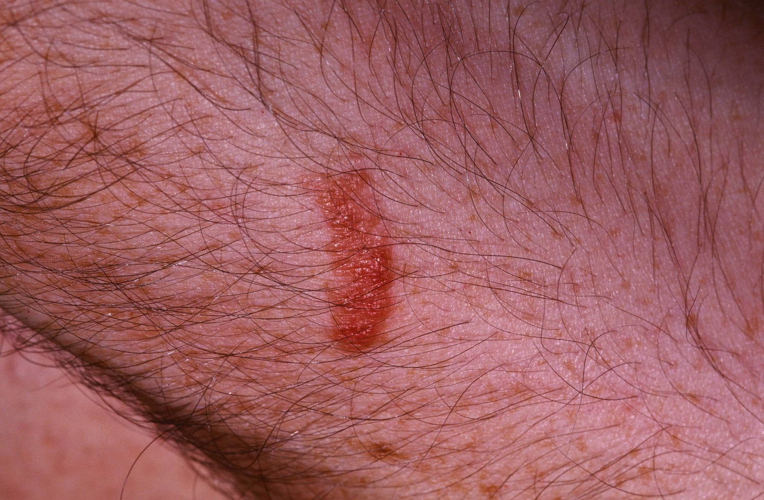 Mild Poison Ivy On Skin